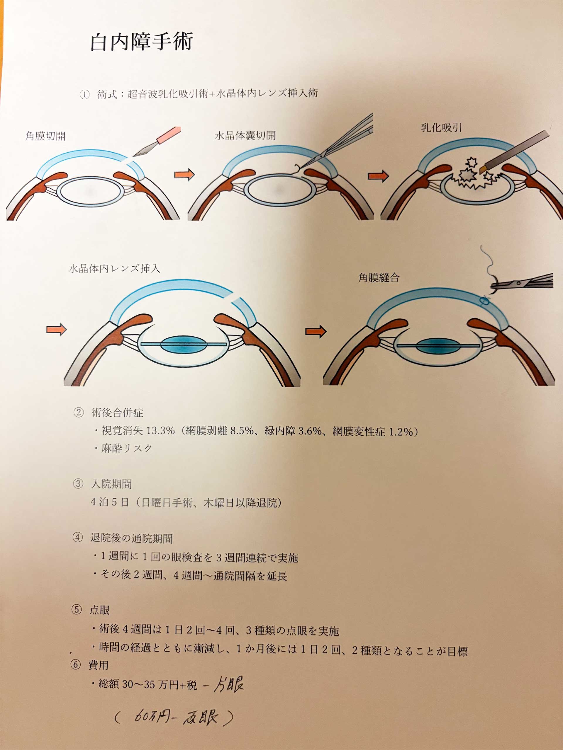 白内障手術について.jpg